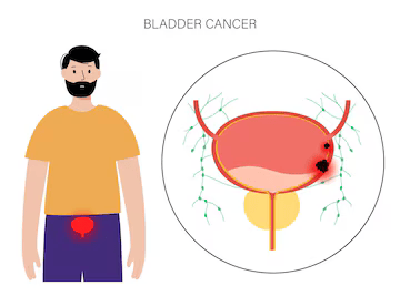 Bladder Cancer