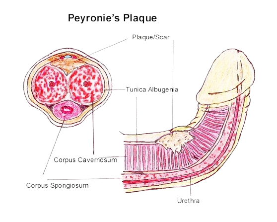 Peyronie’s Disease